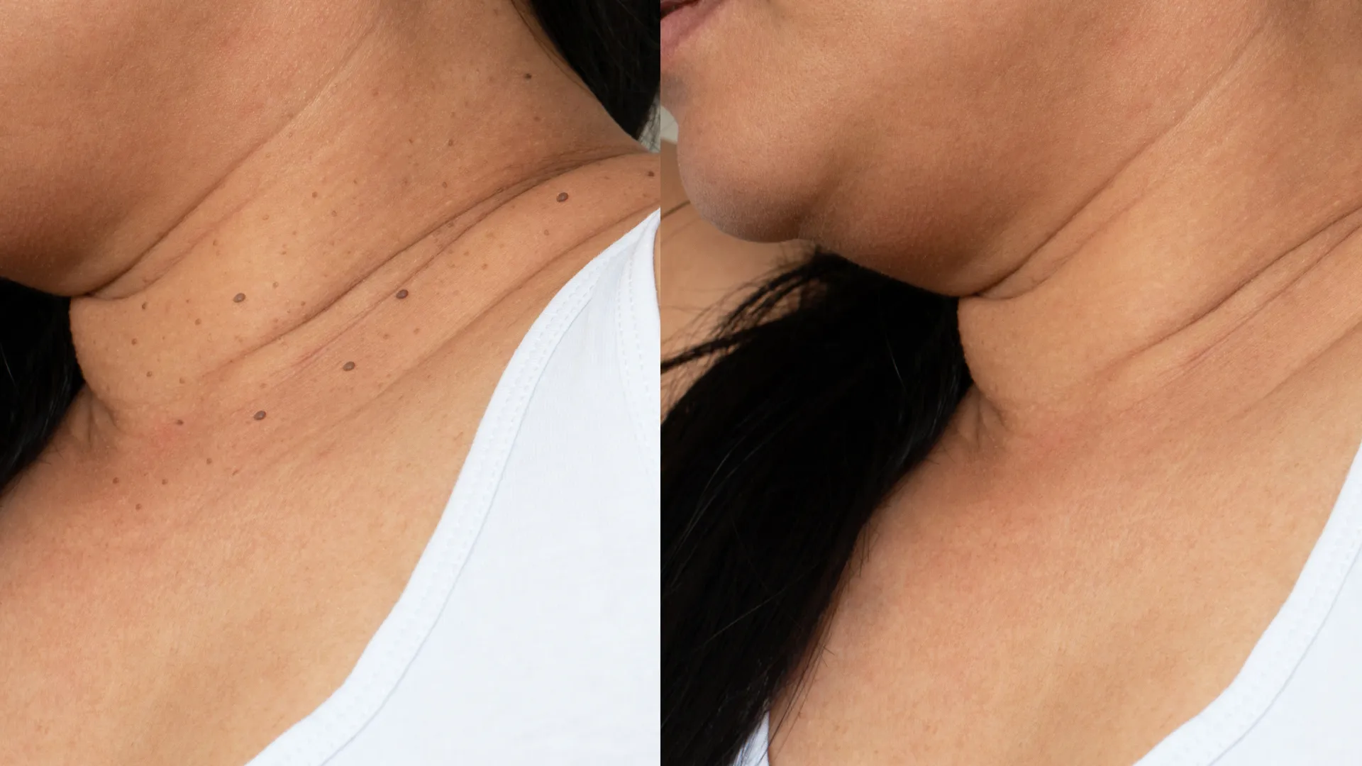 Skin Tag Removal